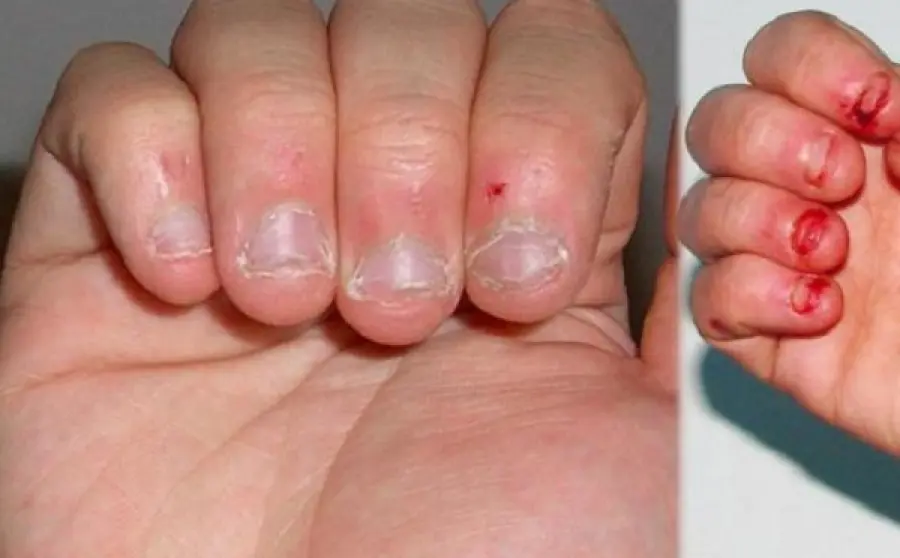 Mangiare le unghie è rischioso per la salute, questi i motivi