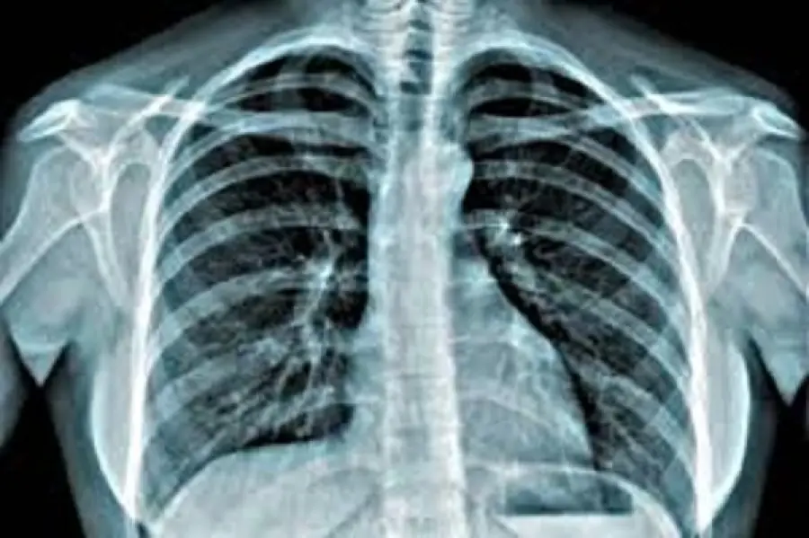 Tumore al polmone: una fondazione premia i centri di cura migliori