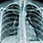 Tumore al polmone: una fondazione premia i centri di cura migliori