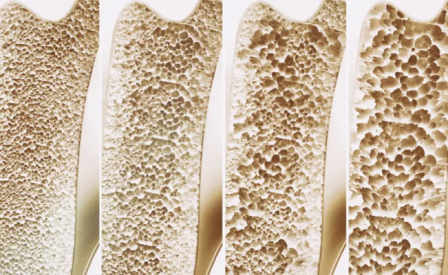 Osteoporosi: tutte le fake news del web. Ecco come difendersi