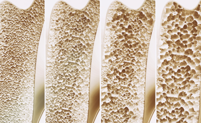 Osteoporosi: tutte le fake news del web. Ecco come difendersi