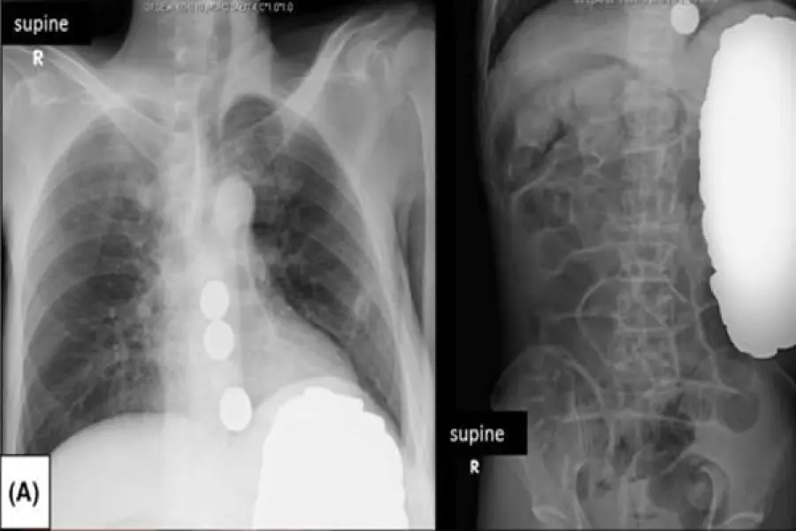 Sindrome di Pica: trovate 2mila monete nello stomaco
