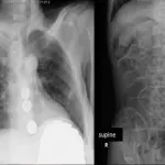 Sindrome di Pica: trovate 2mila monete nello stomaco