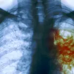 Tubercolosi, a Bologna torna la paura. I casi sono 67