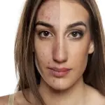 Acne, in arrivo un vaccino per guarire da brufoli e punti neri