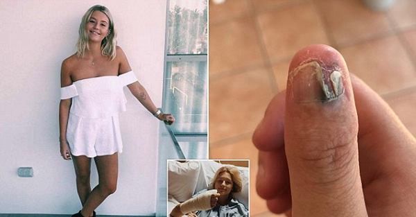 Mangia le unghie per il forte stress: 20enne sviluppa cancro alla pelle e le amputano il pollice