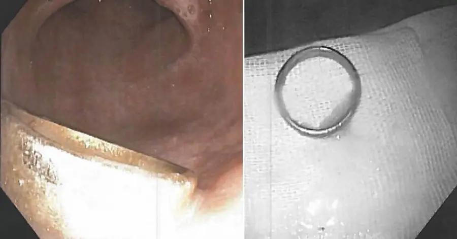 Perde la fede nuziale della moglie defunta e si sente male; I medici la trovano nel suo addome