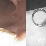 Perde la fede nuziale della moglie defunta e si sente male; I medici la trovano nel suo addome