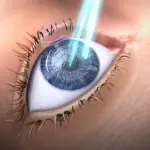 Chirurgia refrattiva: quanto costa davvero