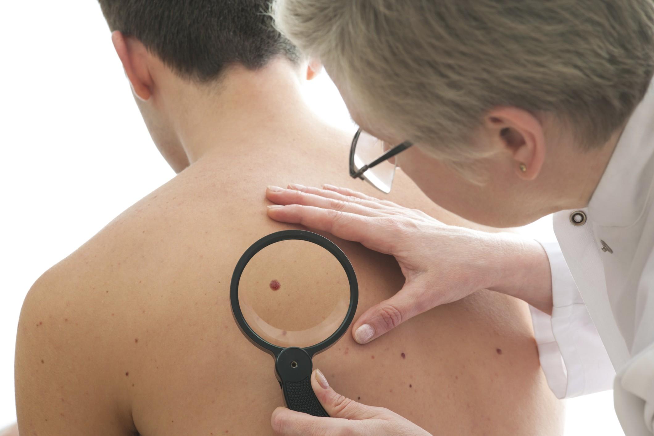 Neo che cambia aspetto: sintomo di melanoma?