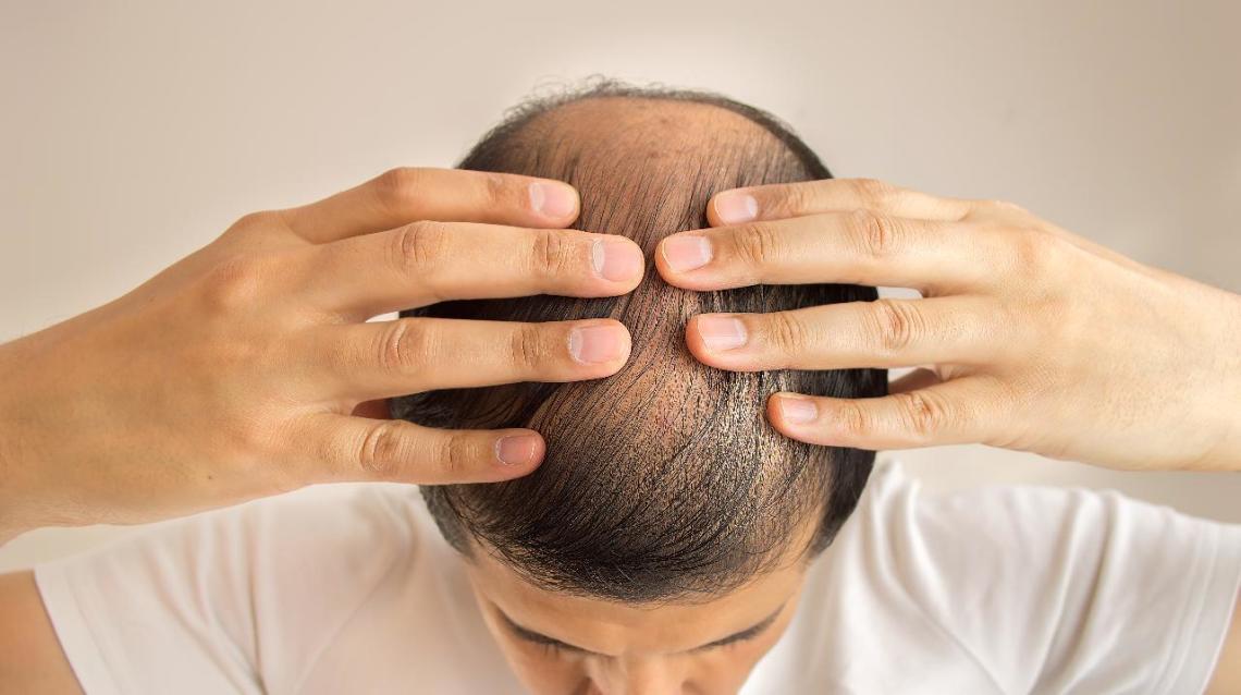 Caduta dei capelli: nuova sostanza potrebbe prevenirla
