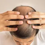 Caduta dei capelli: nuova sostanza potrebbe prevenirla