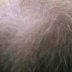 Protesi per capelli: la soluzione rapida e efficace per ogni tipo di calvizie