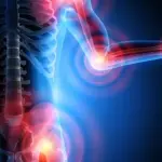 Malattie reumatiche favorite dall'alimentazione scorretta