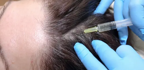 Calvizie si può curare con la terapia Prp: cos'è?