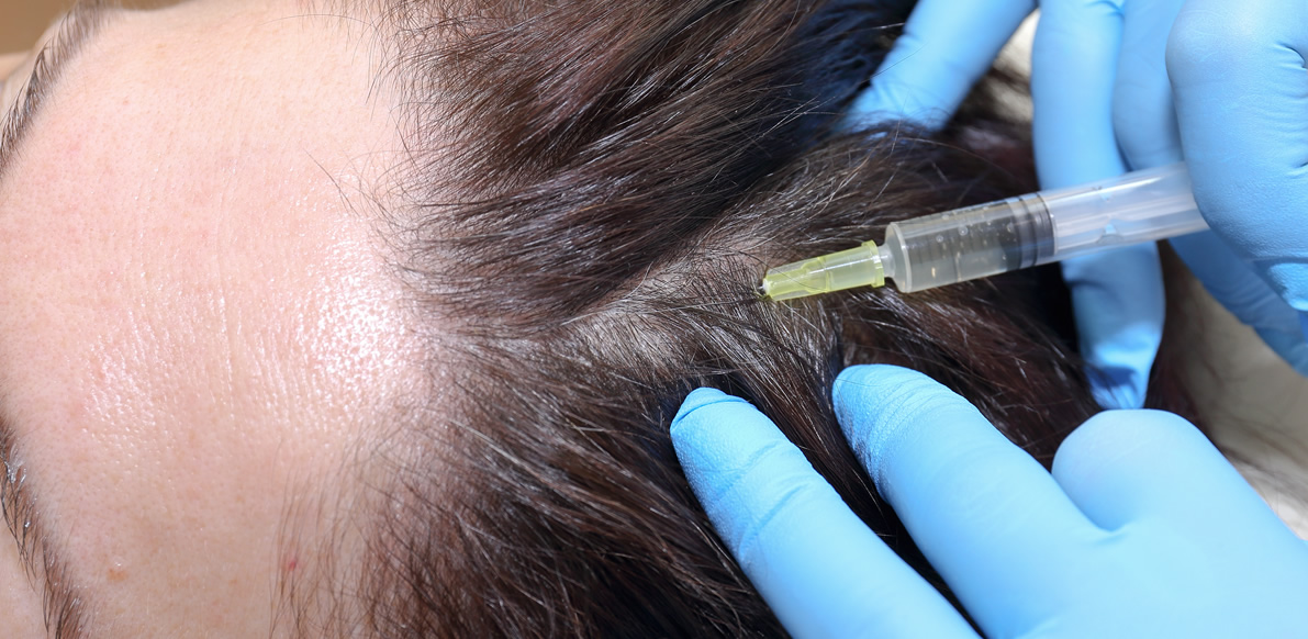 Calvizie si può curare con la terapia Prp: cos'è?