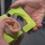 Orecchio ricostruito con la stampa 3D a pazienti affetti da microtia