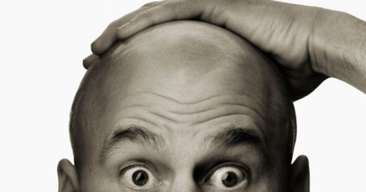Calvizie precoce e infarto: un presunto terribile binomio