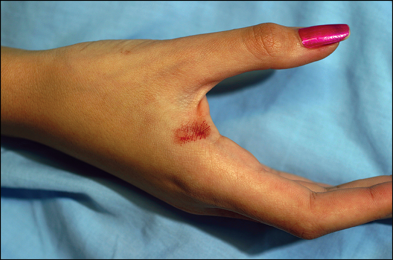 Suda sangue quando è stressata: ragazza di Firenze stupisce medici