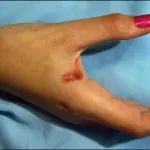 Suda sangue quando è stressata: ragazza di Firenze stupisce medici