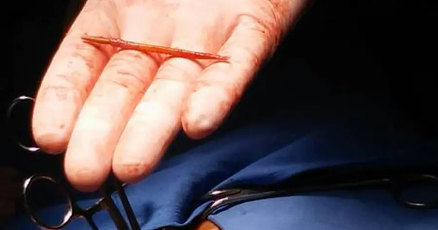 Viveva con uno stuzzicadenti nel cuore ma non sentiva dolore