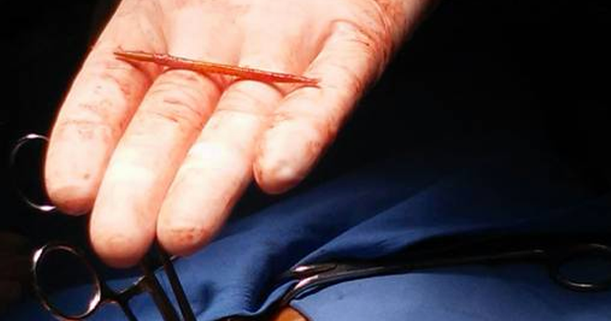 Viveva con uno stuzzicadenti nel cuore ma non sentiva dolore