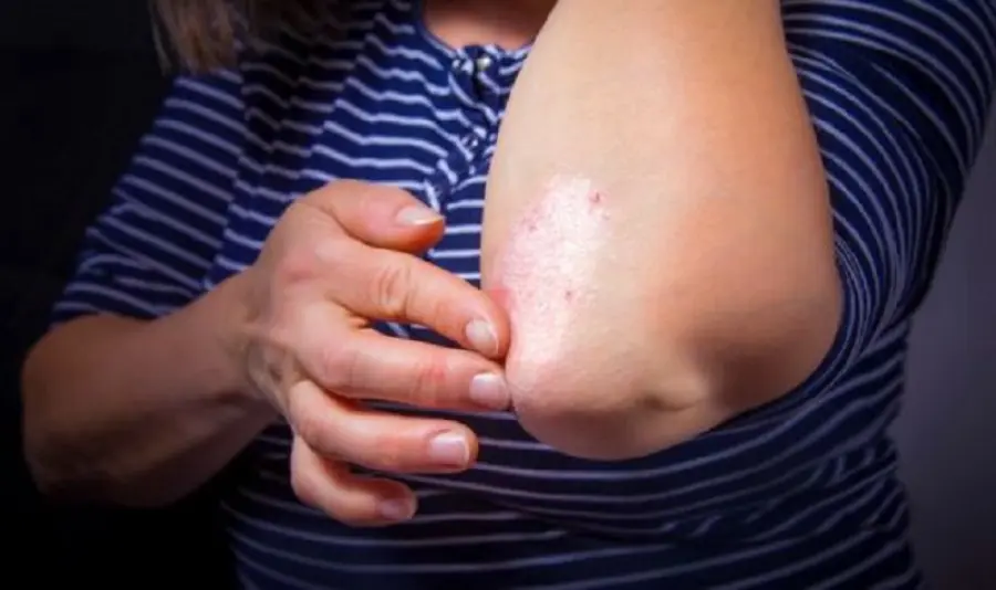 Psoriasi, colpiti più di 2 milioni di italiani: cause, sintomi e soluzioni