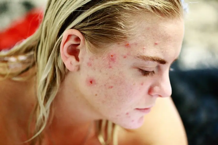 Acne: cos'è, rimedi e cure di bellezza per tenerla sotto controllo