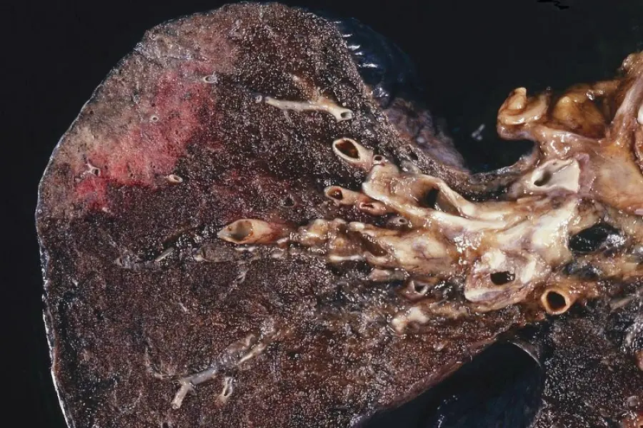 Tumore ai polmoni curabile con Keytruda, chemio non serve