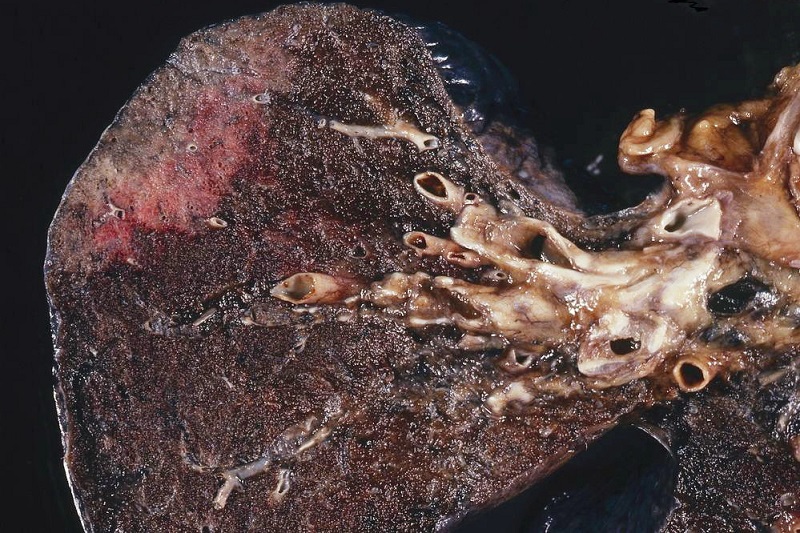 Tumore ai polmoni curabile con Keytruda, chemio non serve