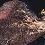 Tumore ai polmoni curabile con Keytruda, chemio non serve