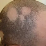 Come curare alopecia areata? Con farmaco anti artrite