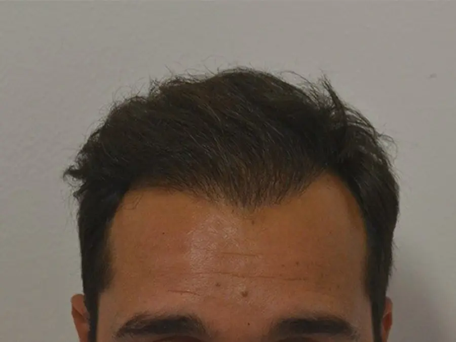 Trapianto: perché non è la soluzione alla calvizie