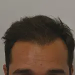 Trapianto: perché non è la soluzione alla calvizie