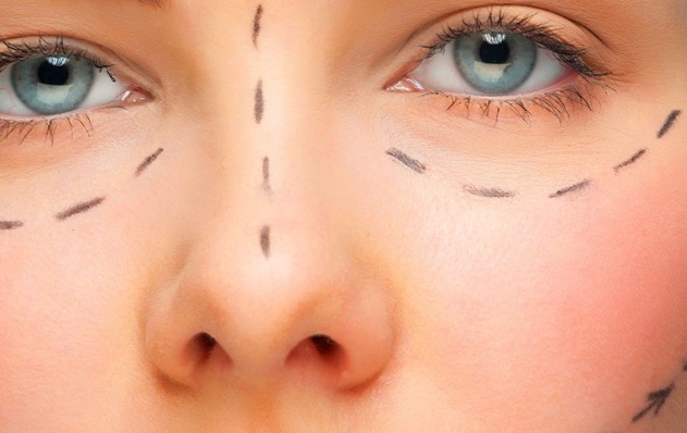 Rinoplastica, un intervento sempre più richiesto