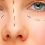 Rinoplastica, un intervento sempre più richiesto