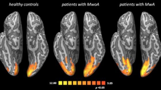 Emicrania: ecco come modifica il cervello, foto su Chephalagia