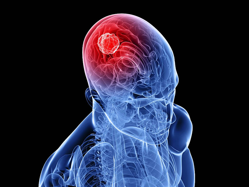 Glioblastoma: studiosi italiani scoprono proteina che lo rafforza