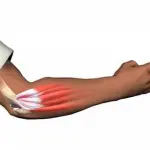 Trapianto di gomito preso da cadavere, paziente ora flette braccio