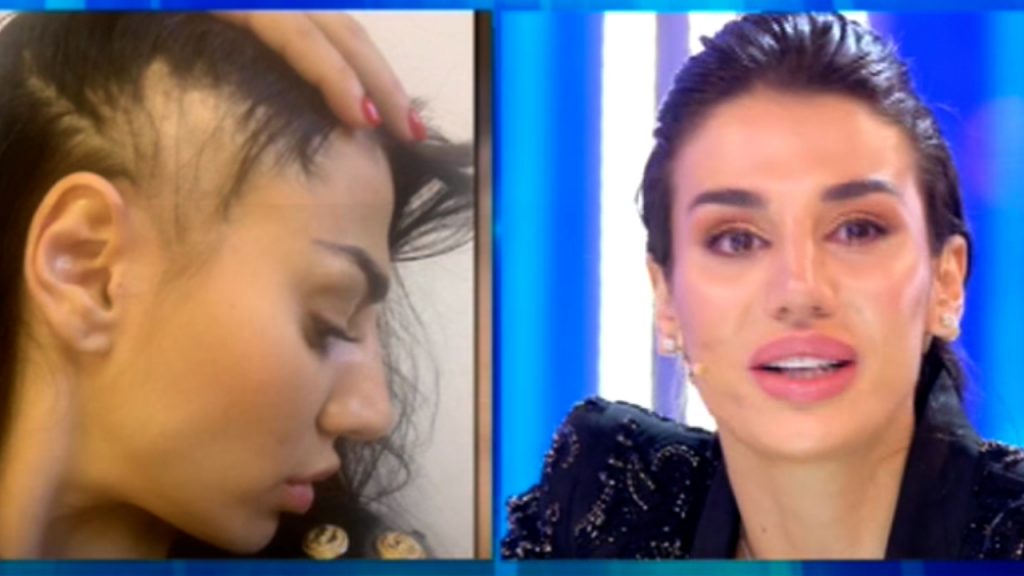 Patrizia Bonetti in lacrime dopo l'aggressione: "Adesso ho una protesi"