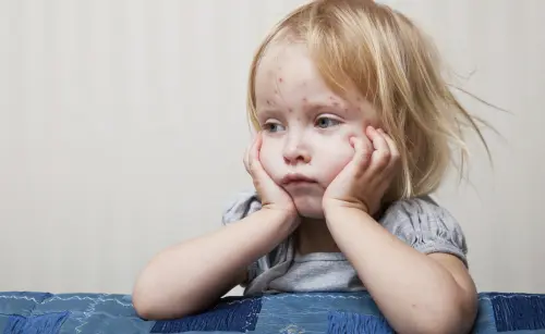 Morbillo, Boom Casi per Fuga dai Vaccini: Patologia Può Portare alla Morte