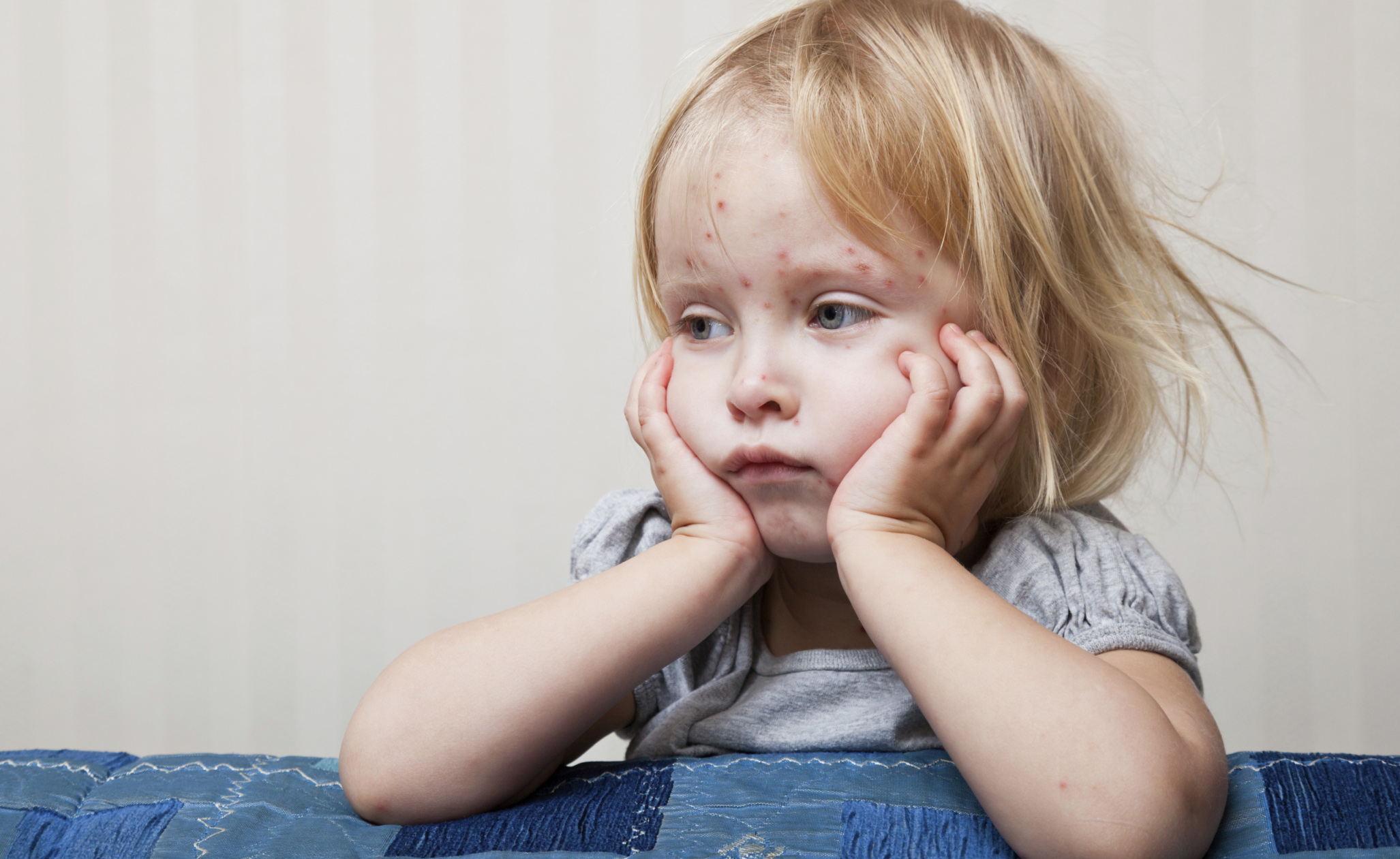 Morbillo, Boom Casi per Fuga dai Vaccini: Patologia Può Portare alla Morte