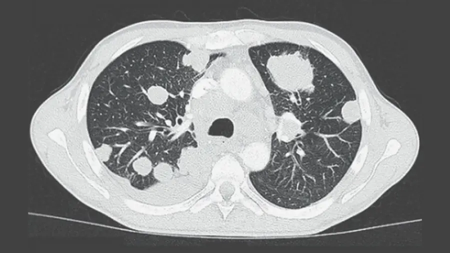 Colombiano Ucciso da un Verme: Tenia Trasmette Cancro, Primo Caso al Mondo