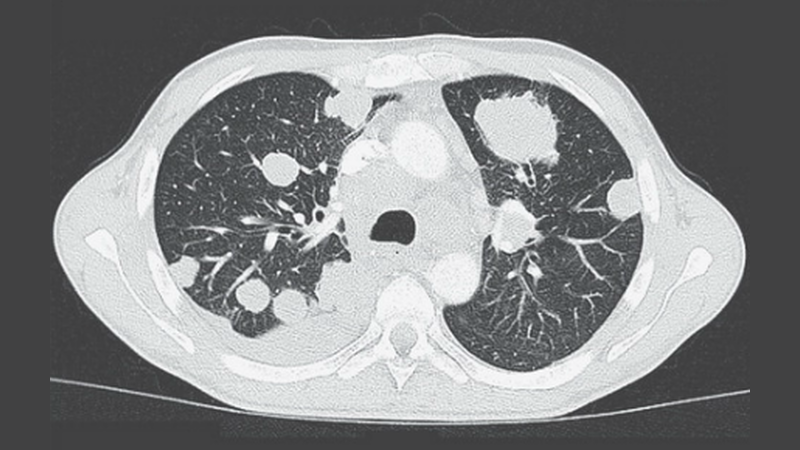 Colombiano Ucciso da un Verme: Tenia Trasmette Cancro, Primo Caso al Mondo
