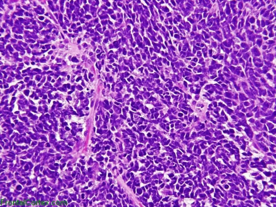 Tumore al Cervello nei Bimbi: 'Stop Molecolare' lo Disinnesca