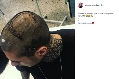 Francesco Chiofalo mostra la cicatrice su Instagram: 
