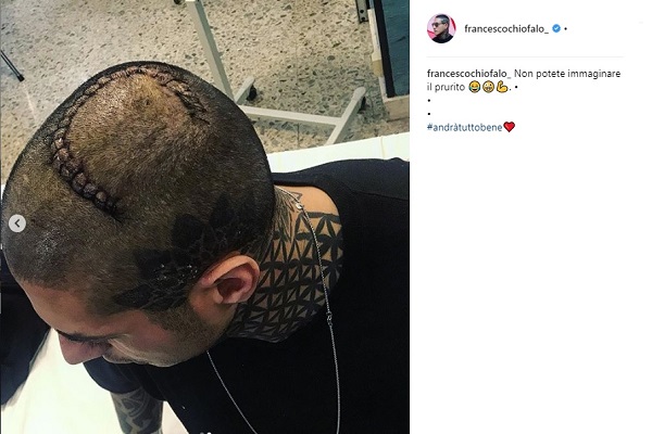 Francesco Chiofalo mostra la cicatrice su Instagram: 