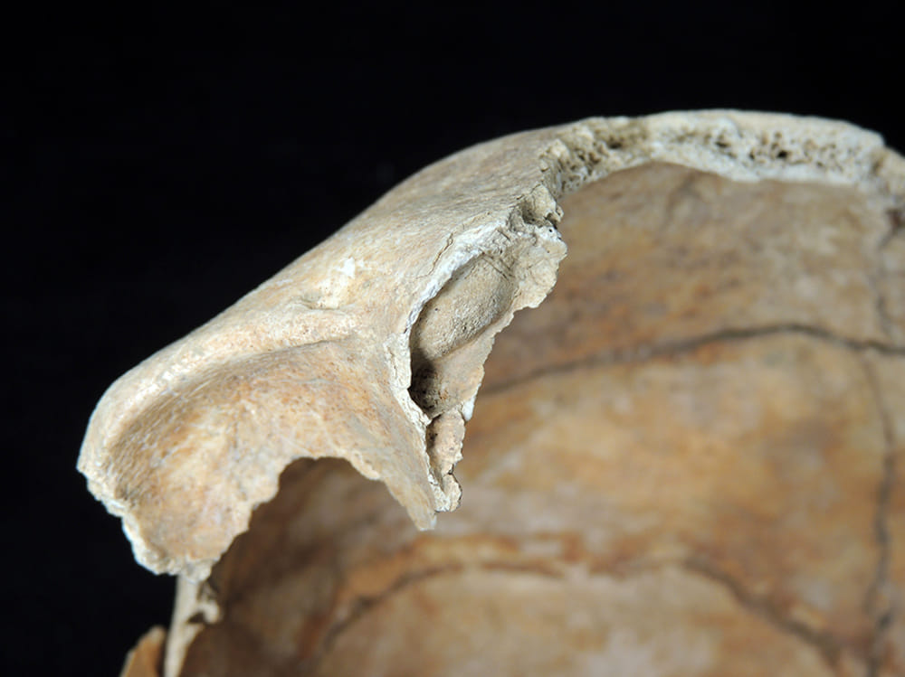 Scheletro del I secolo d.C. malato di cancro: la scoperta importante