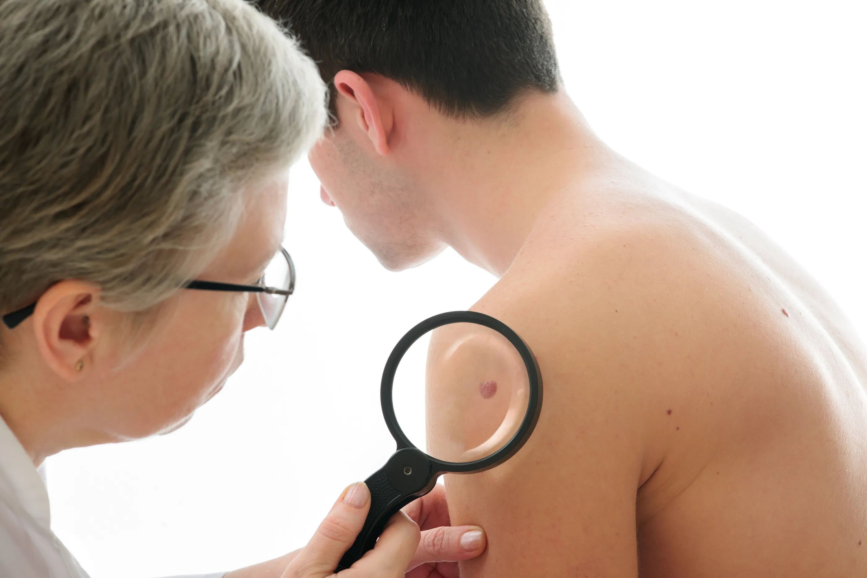 Scoperta molecola che uccide il melanoma maligno