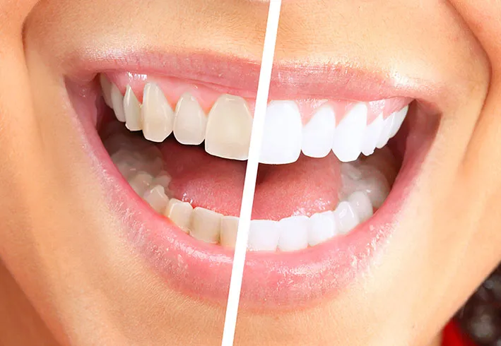 Sbiancamento dei denti, boom di richieste in Italia